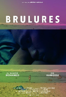 Brûlures